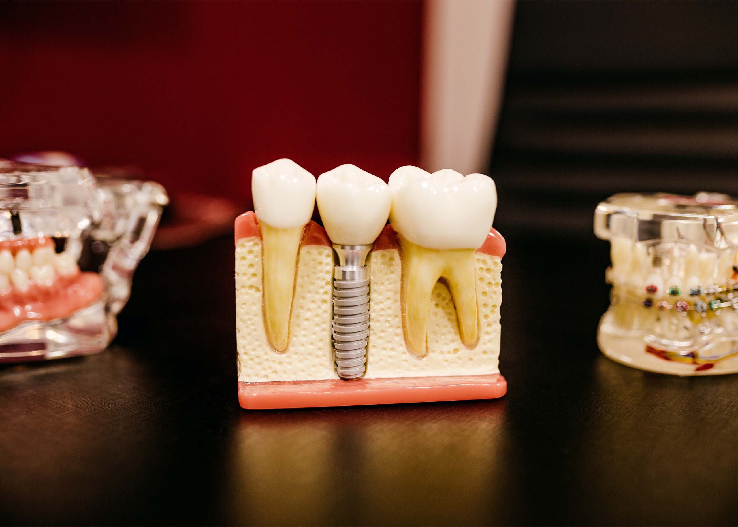 dental-implants