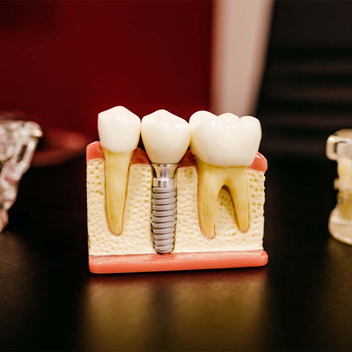 dental implants abu dhabi