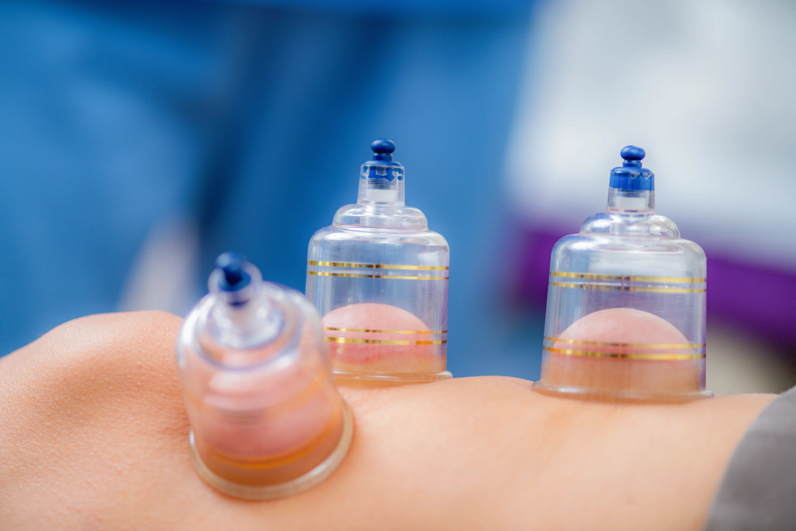 What Hijama Can Cure and Fix in Abu Dhabi at Purecare Medical Center – medical Hijama therapy session